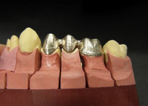 Metallgerüst in verkleinerter Zahnform