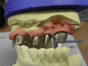 Implantataufbau in Gold mit ergänztem Zahnfleisch